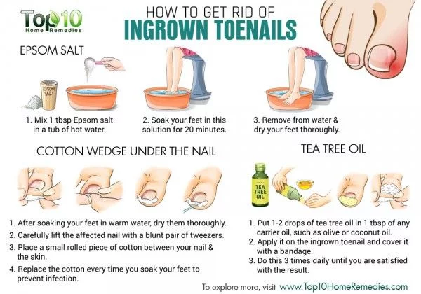 How to Get rid of Ingrown Toenails