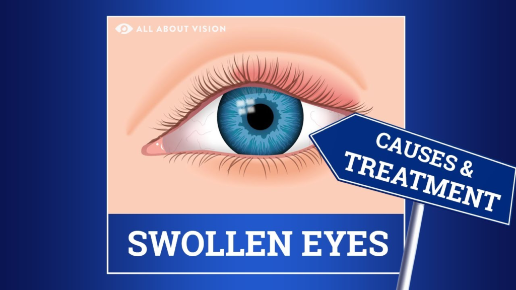 Home Remedies for Eyelid Swelling