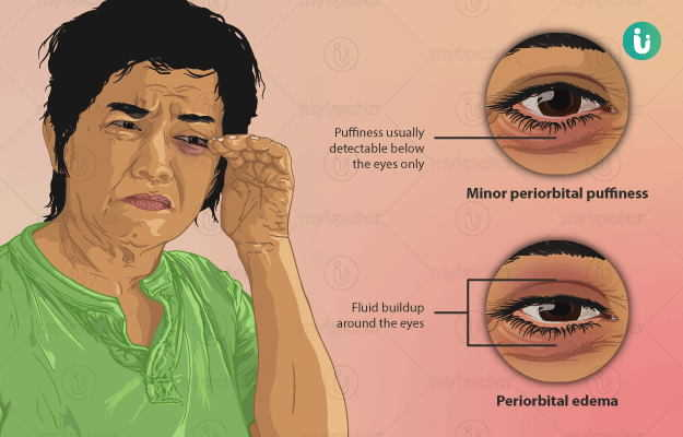 Home Remedies for Eyelid Swelling